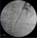 RIRS. Radiología